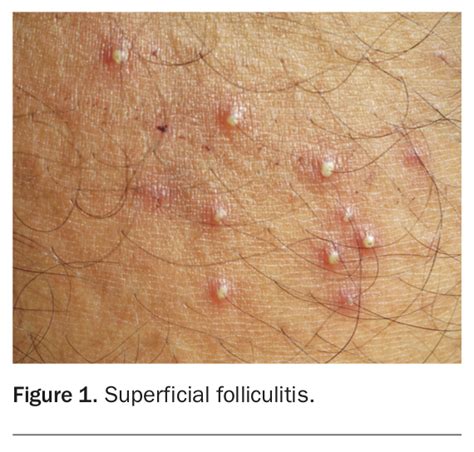 gpnotebook|folliculitis gpnotebook.